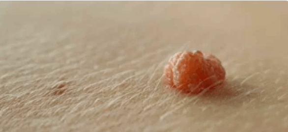 Papilloma -Virus