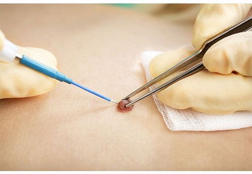 Papillome Elimination