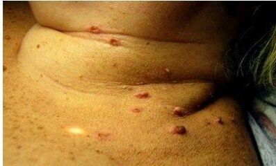 Fotos von vielen Papillomen bei Frauen
