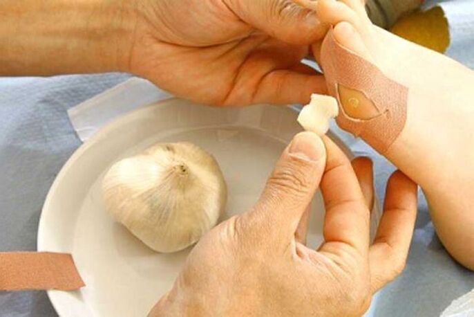 Behandlung von Papillomen mit Knoblauchkompresse.