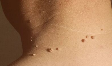 Ursachen von Papillomen