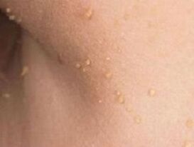 Gründe für das Auftreten von Papillomen am Körper.