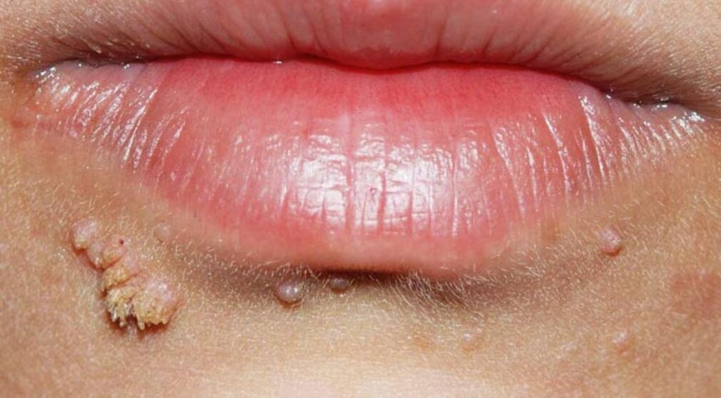 Warzen auf den Lippen