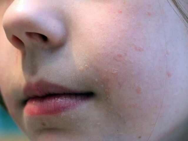 Flache Warzen im Gesicht treten am häufigsten im Jugendalter auf. 