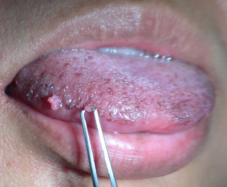 Papillome auf der Zunge